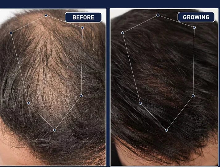 FEG Plus Hair Growth Spray – Fast Hair Regrowth  Men & Women